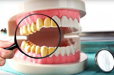 Способы удаления зубного камня в домашних условиях