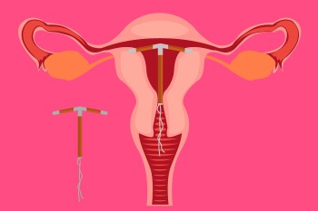 ☰ Установка и удаление внутриматочной спирали ▶ контрацептива — Цена в Киеве