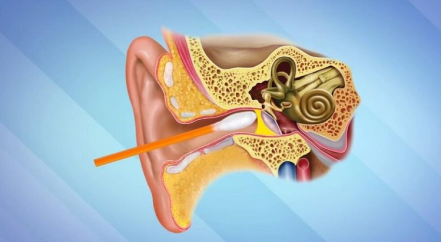 Как пробить пробку в ухе в домашних. Анатомия уха серная пробка. Ушная сера в барабанной перепонке. Строение уха серная пробка. Строение уха человека серная пробка.