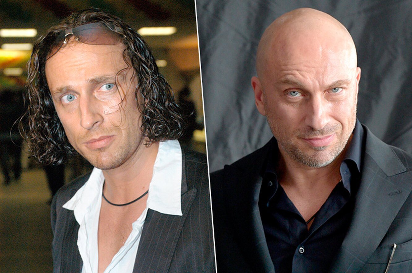 ТОП 7 интересных причин почему люди лысеют